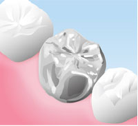 銀歯(保険適用)