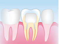 ファイバーコア(保険適用外)