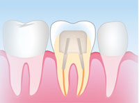 レジンコア(保険適用)