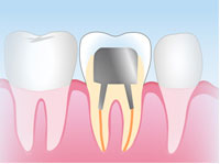 メタルコア(保険適用)