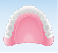 保険の入れ歯（レジン義歯）