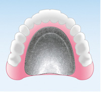 金属床義歯