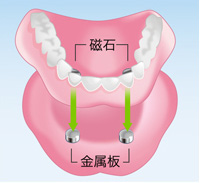 磁性アタッチメント義歯