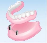 インプラント義歯
