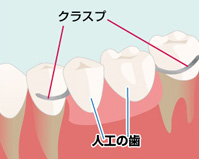 保険の入れ歯(クラスプ義歯)