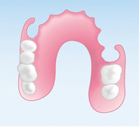 ノンクラスプデンチャー
