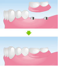 磁性アタッチメント義歯