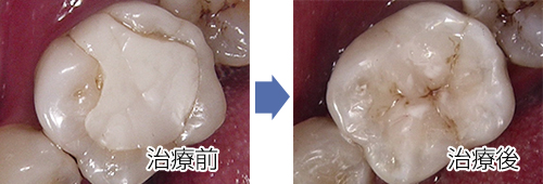 銀歯(保険適用)