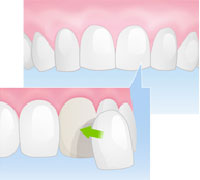 ラミネートべニア
