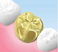 ゴールドクラウン・インレー