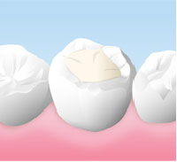 コンポジットレジン(保険適用)