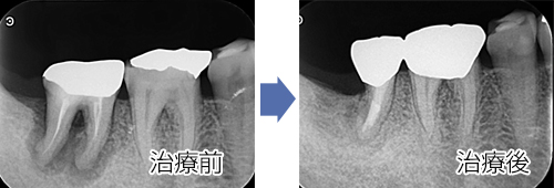銀歯(保険適用)